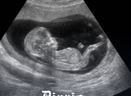 Un video de ultrasonido de un bebé tratando de escapar mientras un abortista desgarra su cuerpo durante un aborto por desmembramiento se está volviendo viral en las redes sociales, y muchos están conmocionados por la realidad del aborto.