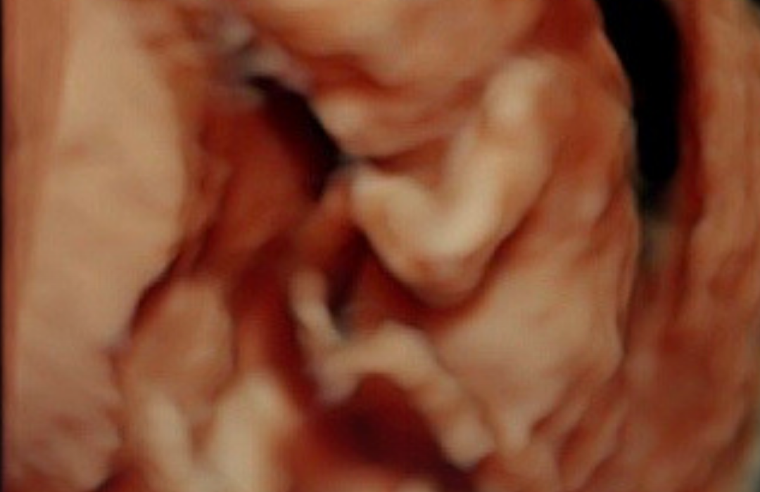 Abortista cortó las extremidades del bebé y dejó el resto del cuerpo dentro de la madre