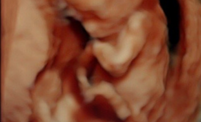 Abortista cortó las extremidades del bebé y dejó el resto del cuerpo dentro de la madre