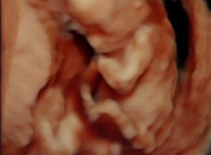 Abortista cortó las extremidades del bebé y dejó el resto del cuerpo dentro de la madre