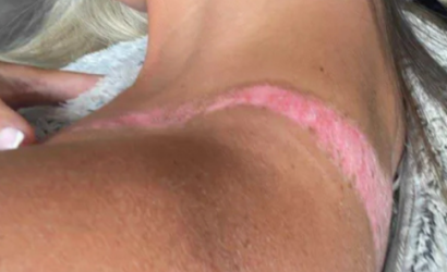 Joven sufrió heridas en la piel al usar prenda comprada en Shein: la retiraron del catálogo
