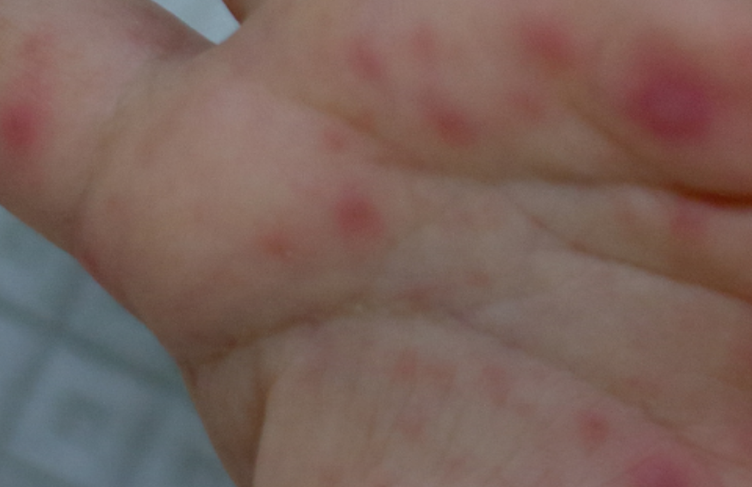 Qué es la enfermedad de boca, mano y pie: la infección que afecta a niños y va al alza en Atacama