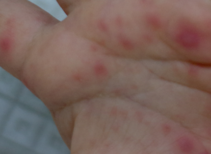 Qué es la enfermedad de boca, mano y pie: la infección que afecta a niños y va al alza en Atacama