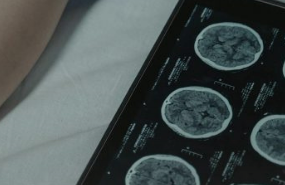 Las tasas de cáncer están aumentando entre personas de 20 a 40 años: ¿Qué dicen los expertos?